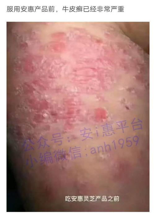 皮肤皮肤病爆料最新消息