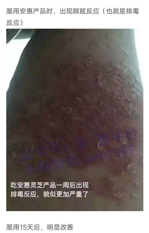 皮肤皮肤病爆料最新消息  第2张