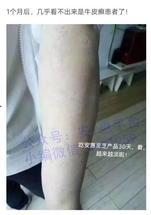 皮肤皮肤病爆料最新消息  第3张